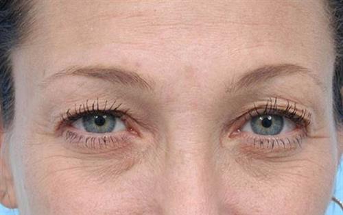 Eyelid Surgery Before Photo | Miami, FL | Baker Plastic Surgery