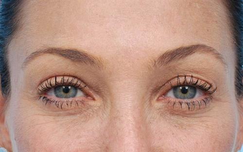 Eyelid Surgery After Photo | Miami, FL | Baker Plastic Surgery