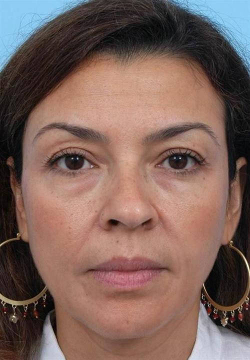 Eyelid Surgery Before Photo | Miami, FL | Baker Plastic Surgery