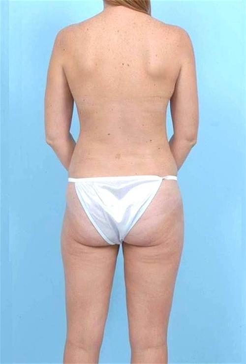 Liposuction After Photo | Miami, FL | Baker Plastic Surgery