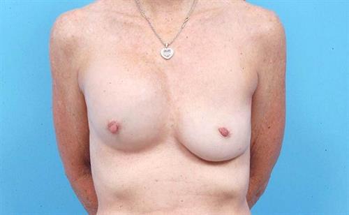 Breast Revision Before Photo | Miami, FL | Baker Plastic Surgery