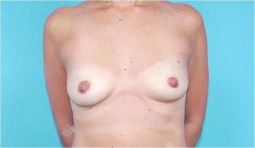 Breast Augmentation Before Photo | Miami, FL | Baker Plastic Surgery