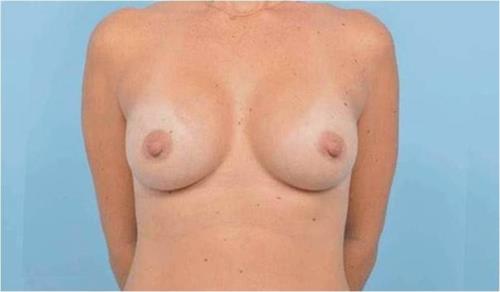 Breast Augmentation After Photo | Miami, FL | Baker Plastic Surgery