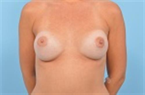 Breast Revision Before Photo | Miami, FL | Baker Plastic Surgery