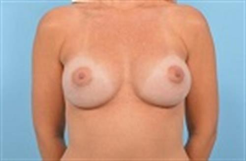 Breast Revision After Photo | Miami, FL | Baker Plastic Surgery