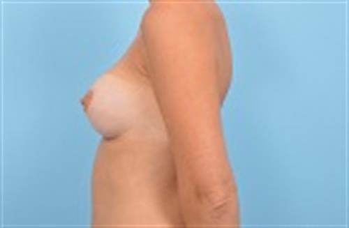 Breast Revision Before Photo | Miami, FL | Baker Plastic Surgery