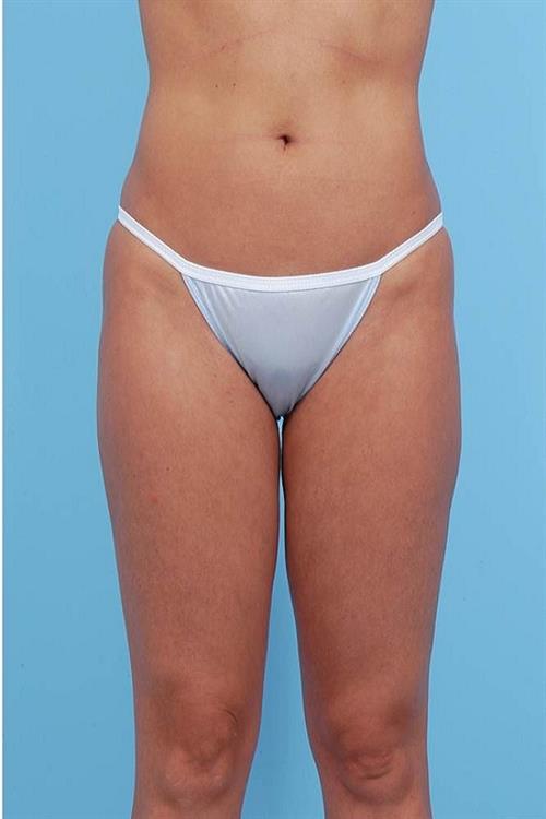 Liposuction After Photo | Miami, FL | Baker Plastic Surgery