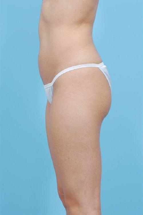 Liposuction Before Photo | Miami, FL | Baker Plastic Surgery