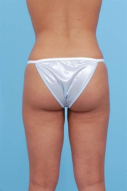 Liposuction After Photo | Miami, FL | Baker Plastic Surgery