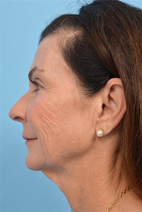 Facelift & Neck Lift Before Photo | Miami, FL | Baker Plastic Surgery