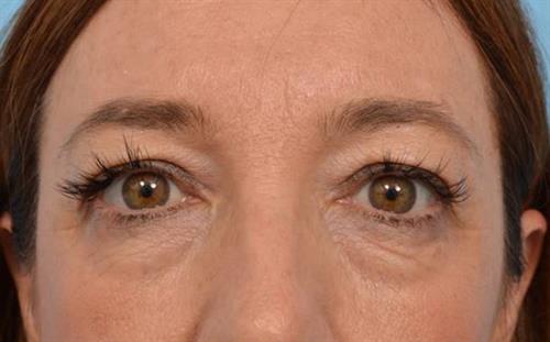 Eyelid Surgery Before Photo | Miami, FL | Baker Plastic Surgery