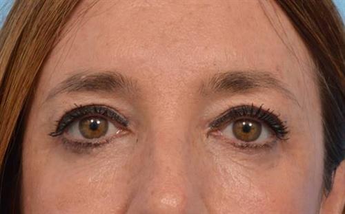 Eyelid Surgery After Photo | Miami, FL | Baker Plastic Surgery