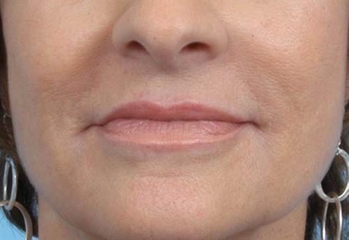 Lip Augmentation After Photo | Miami, FL | Baker Plastic Surgery