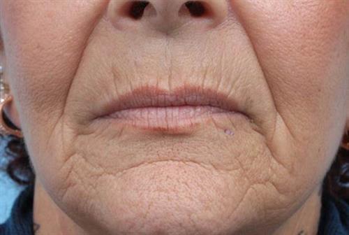 Lip Augmentation Before Photo | Miami, FL | Baker Plastic Surgery