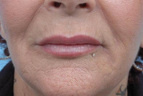 Lip Augmentation After Photo | Miami, FL | Baker Plastic Surgery