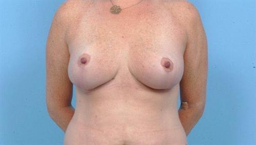 Breast Reduction After Photo | Miami, FL | Baker Plastic Surgery