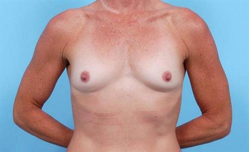 Breast Augmentation Before Photo | Miami, FL | Baker Plastic Surgery