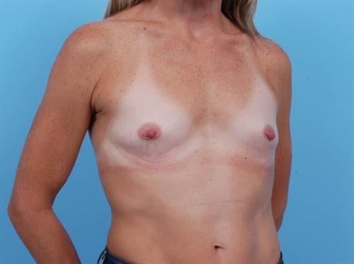 Breast Augmentation Before Photo | Miami, FL | Baker Plastic Surgery