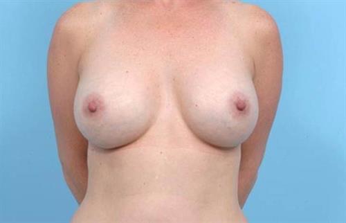 Breast Augmentation After Photo | Miami, FL | Baker Plastic Surgery