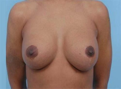 Breast Lift After Photo | Miami, FL | Baker Plastic Surgery