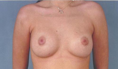 Breast Augmentation After Photo | Miami, FL | Baker Plastic Surgery