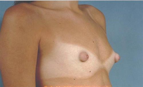 Breast Augmentation Before Photo | Miami, FL | Baker Plastic Surgery