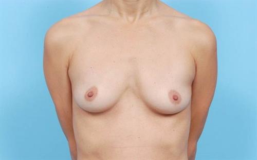 Breast Augmentation Before Photo | Miami, FL | Baker Plastic Surgery