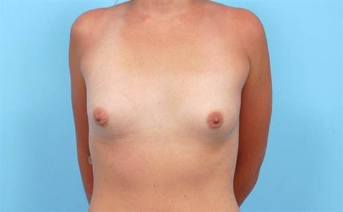 Breast Augmentation Before Photo | Miami, FL | Baker Plastic Surgery