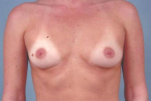 Breast Augmentation Before Photo | Miami, FL | Baker Plastic Surgery