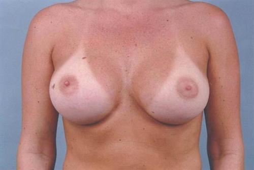 Breast Augmentation After Photo | Miami, FL | Baker Plastic Surgery