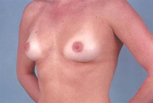 Breast Augmentation Before Photo | Miami, FL | Baker Plastic Surgery