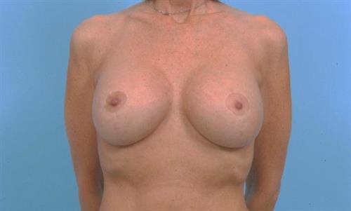 Breast Lift After Photo | Miami, FL | Baker Plastic Surgery