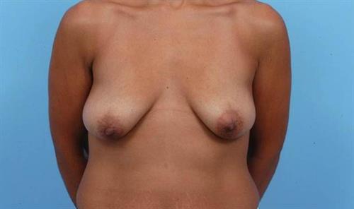 Breast Lift Before Photo | Miami, FL | Baker Plastic Surgery