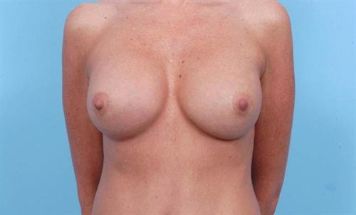 Breast Revision After Photo | Miami, FL | Baker Plastic Surgery