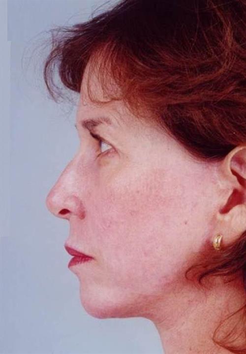 Facelift & Neck Lift After Photo | Miami, FL | Baker Plastic Surgery