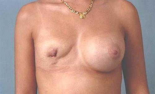 Breast Revision Before Photo | Miami, FL | Baker Plastic Surgery