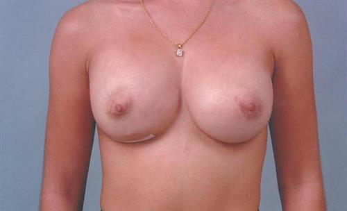 Breast Revision After Photo | Miami, FL | Baker Plastic Surgery