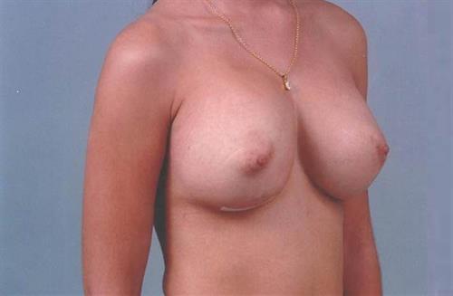 Breast Revision After Photo | Miami, FL | Baker Plastic Surgery