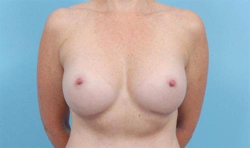 Breast Revision After Photo | Miami, FL | Baker Plastic Surgery