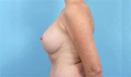 Breast Revision After Photo | Miami, FL | Baker Plastic Surgery