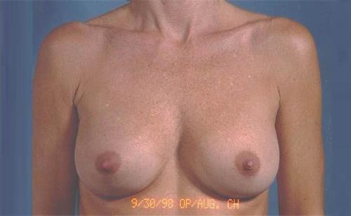 Breast Revision After Photo | Miami, FL | Baker Plastic Surgery