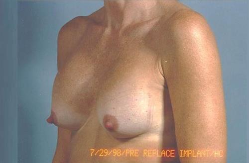 Breast Revision Before Photo | Miami, FL | Baker Plastic Surgery
