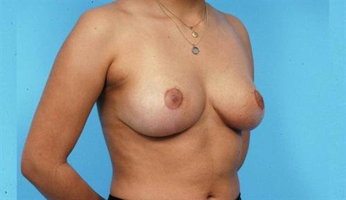 Breast Reduction After Photo | Miami, FL | Baker Plastic Surgery