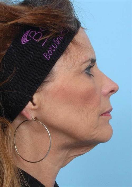 Facelift & Neck Lift Before Photo | Miami, FL | Baker Plastic Surgery