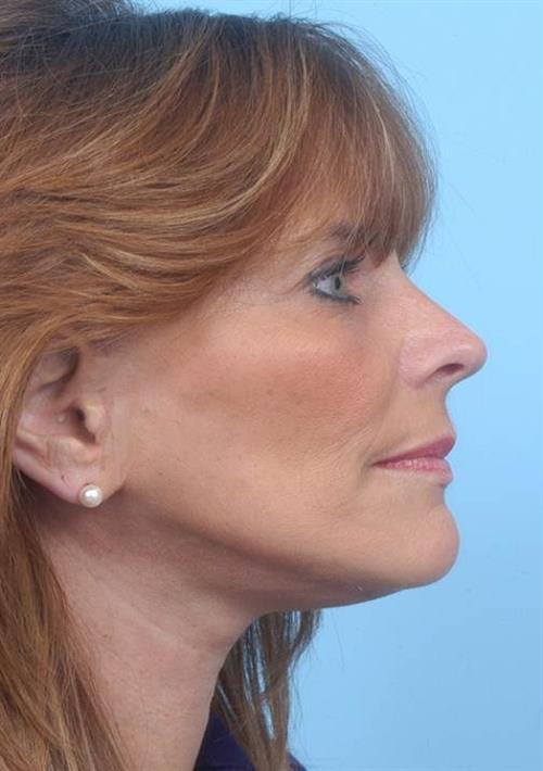 Facelift & Neck Lift After Photo | Miami, FL | Baker Plastic Surgery