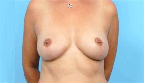 Breast Reduction After Photo | Miami, FL | Baker Plastic Surgery