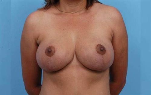 Breast Reduction After Photo | Miami, FL | Baker Plastic Surgery