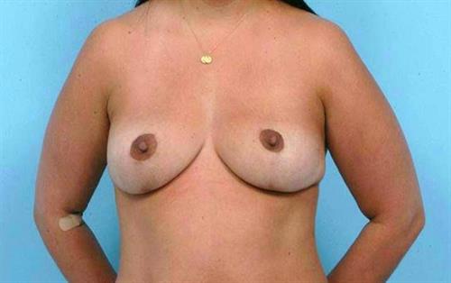 Breast Reduction After Photo | Miami, FL | Baker Plastic Surgery
