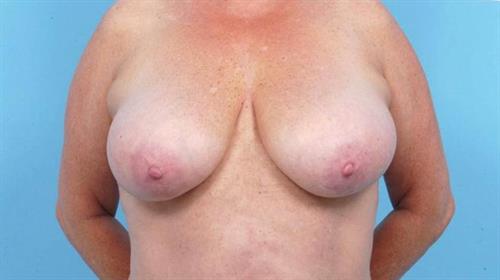 Breast Reduction Before Photo | Miami, FL | Baker Plastic Surgery