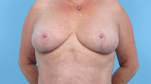 Breast Reduction After Photo | Miami, FL | Baker Plastic Surgery